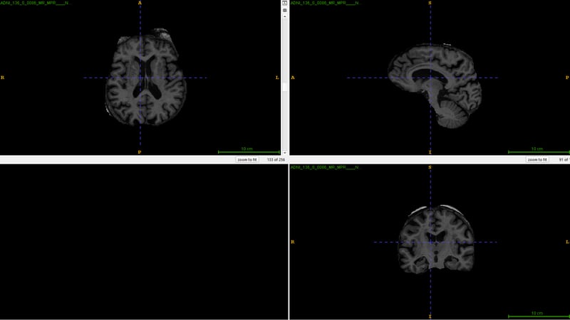 Skull Stripped 3D Brain MRI image after the preprocessing