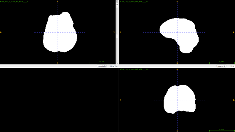 Applied brain mask on the raw 3D brain MRI image